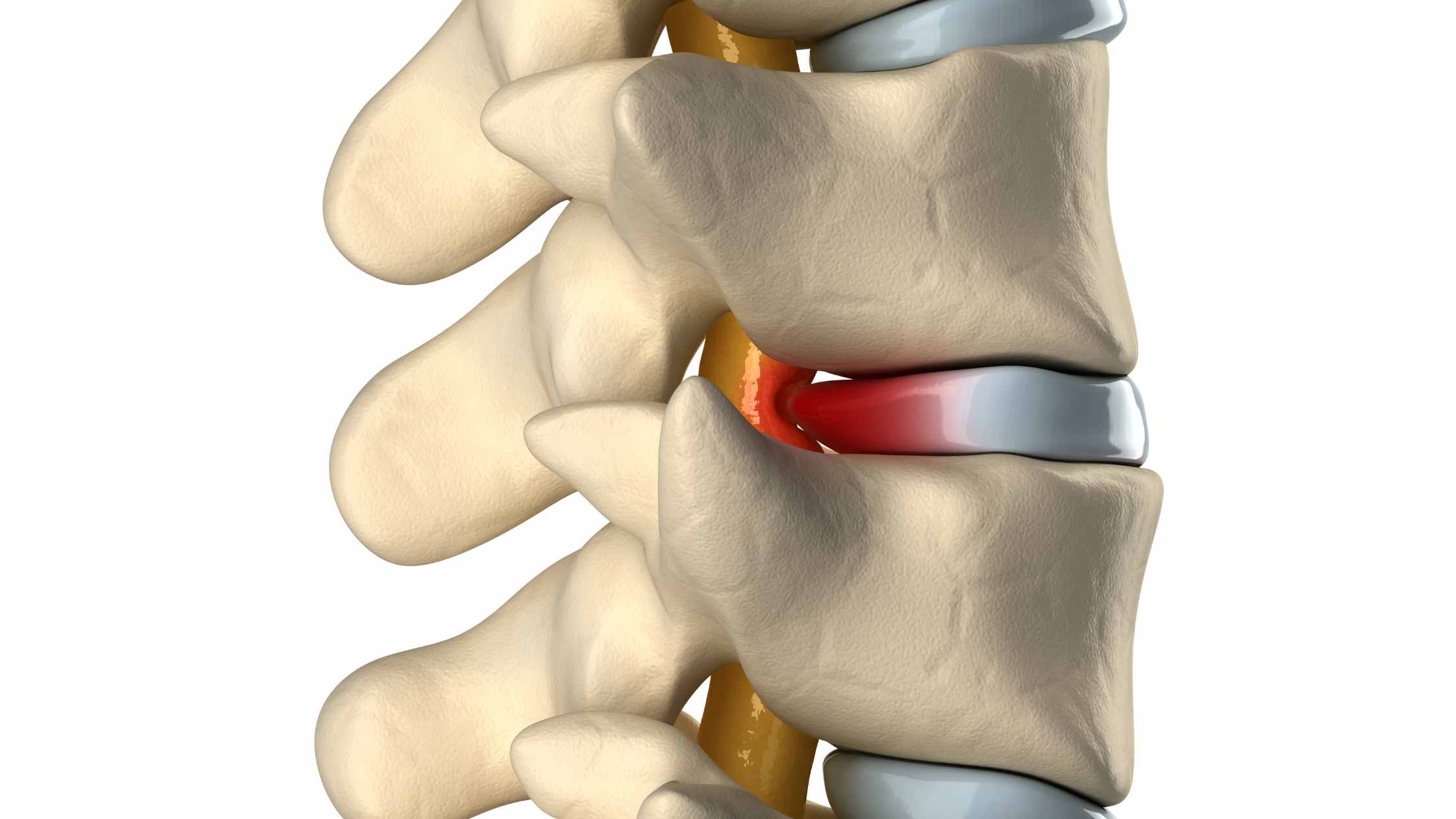 disc bulge
