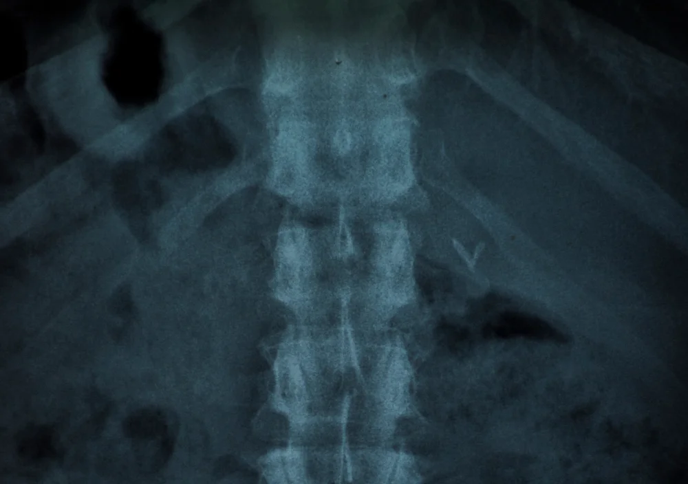 Spinal Fracture Treatment In Dubai